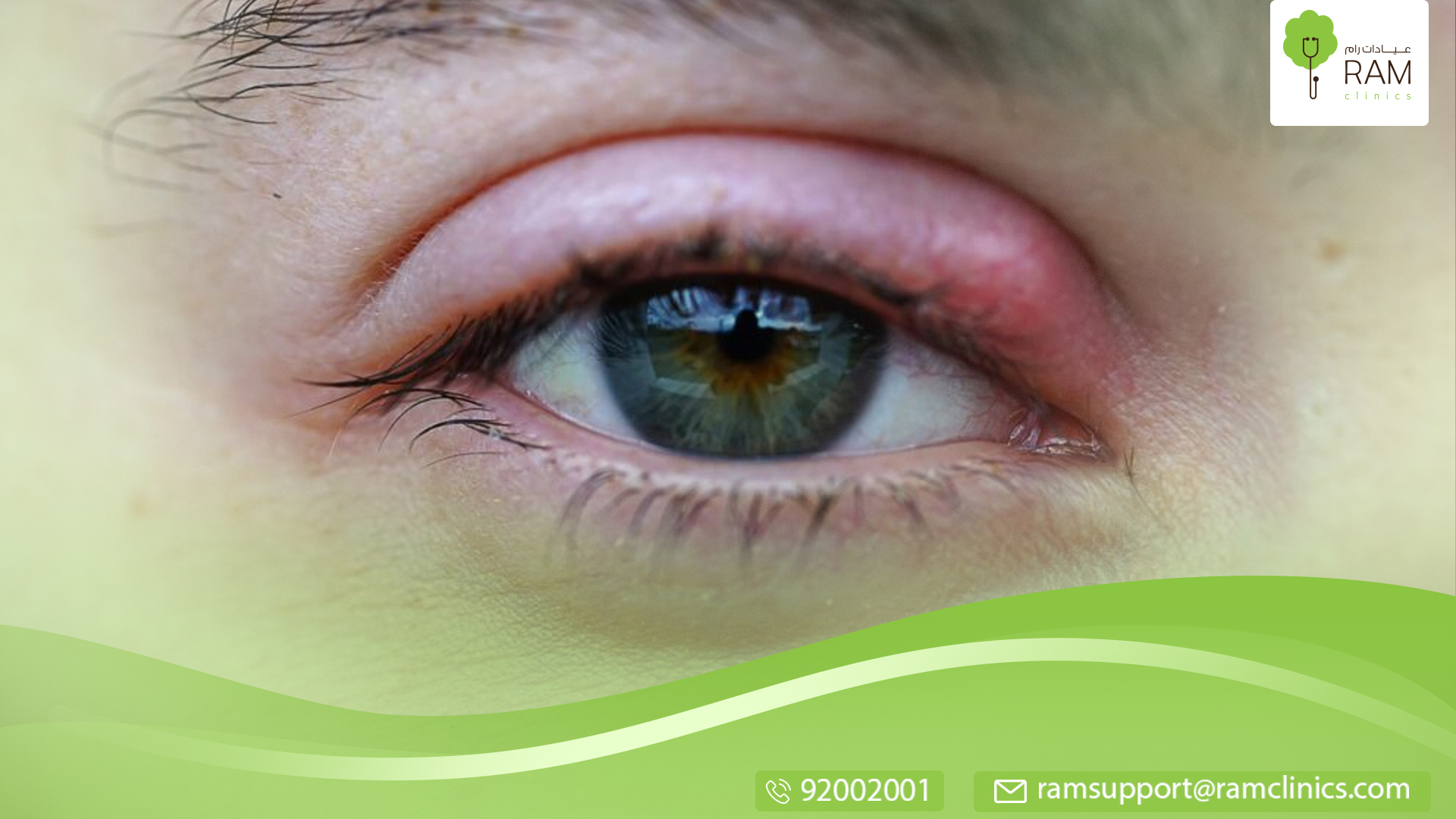 التهابات العين الفيروسي