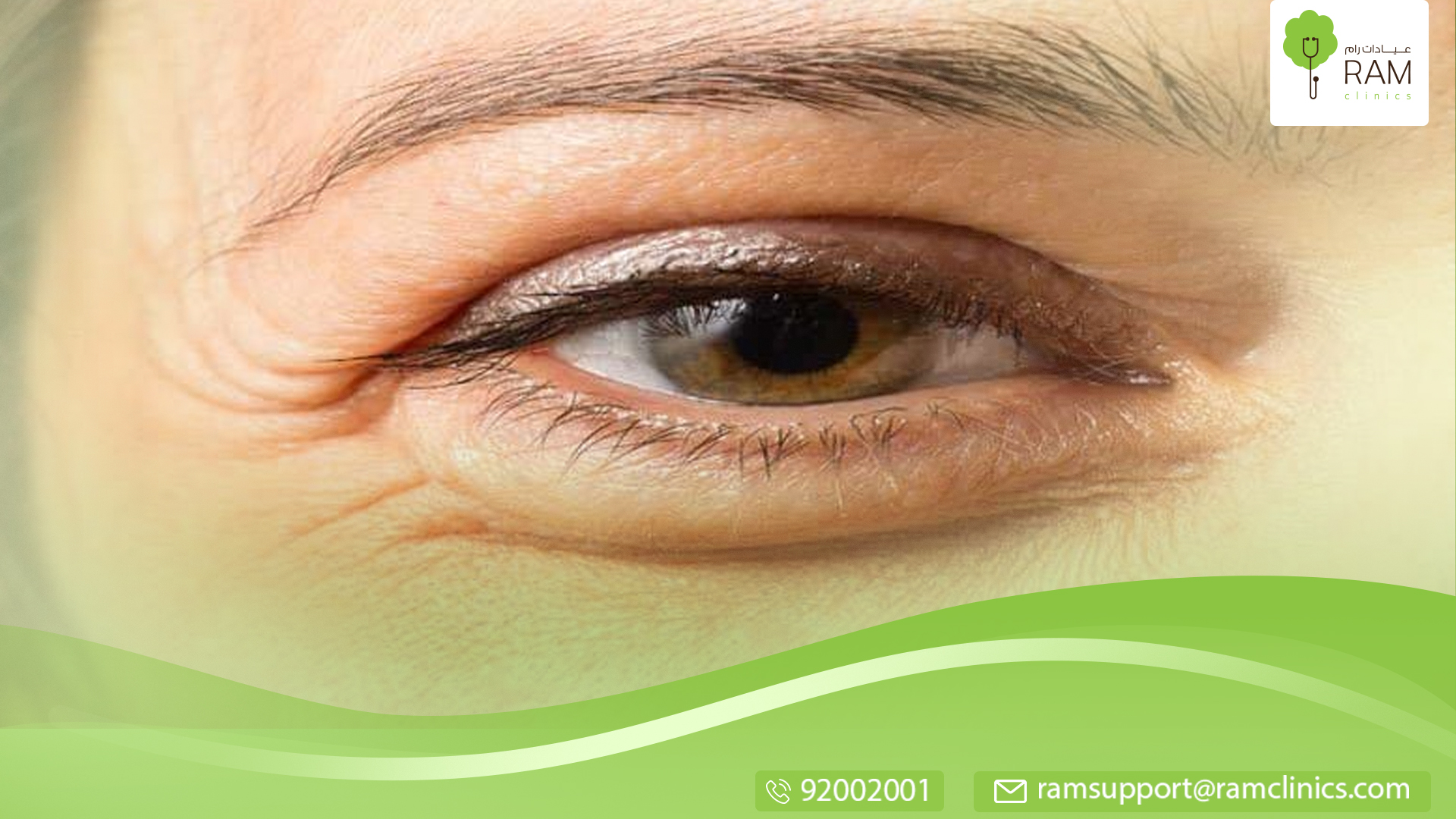 نتفاخات جفن العين