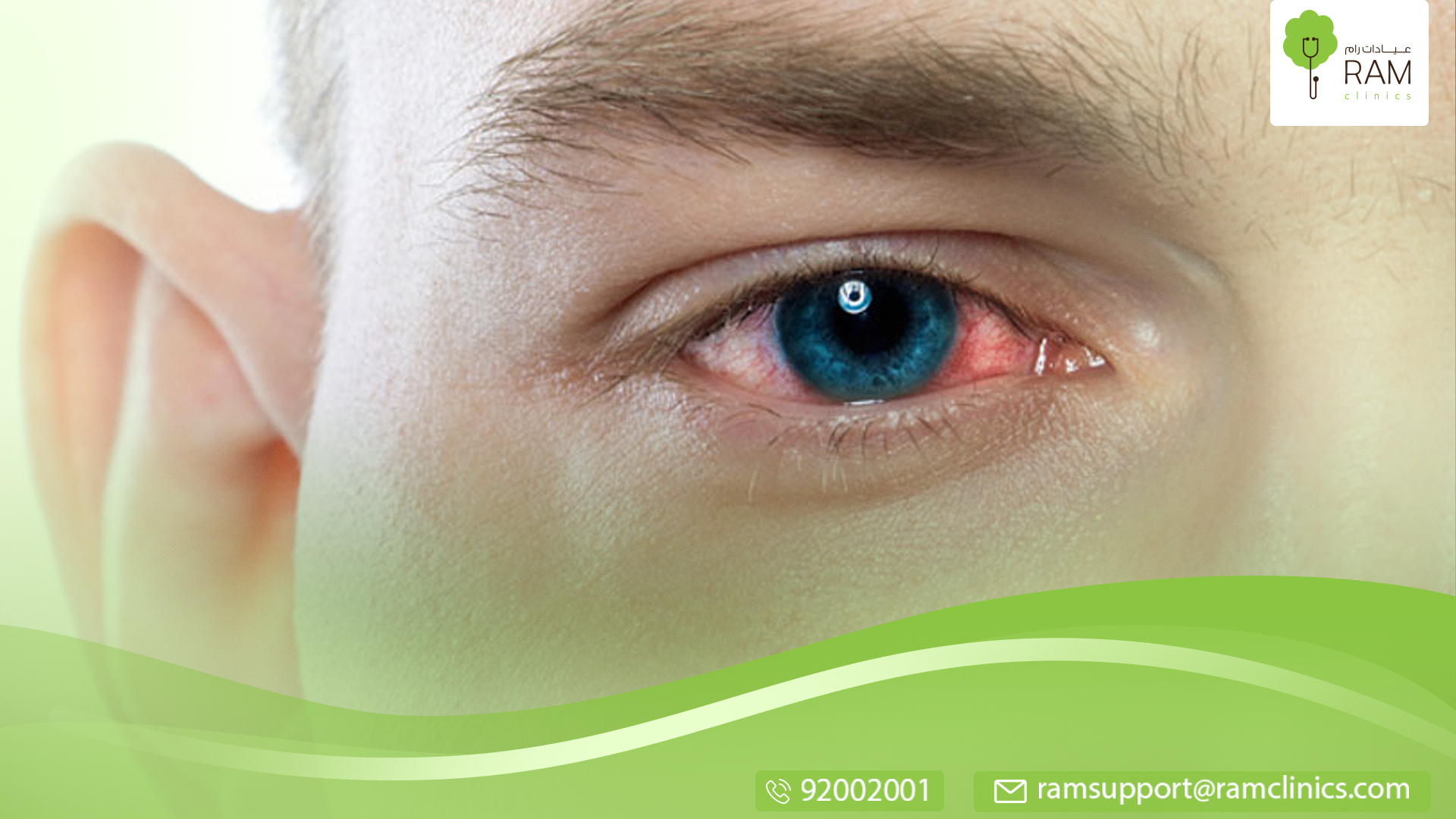 التهاب- العيون