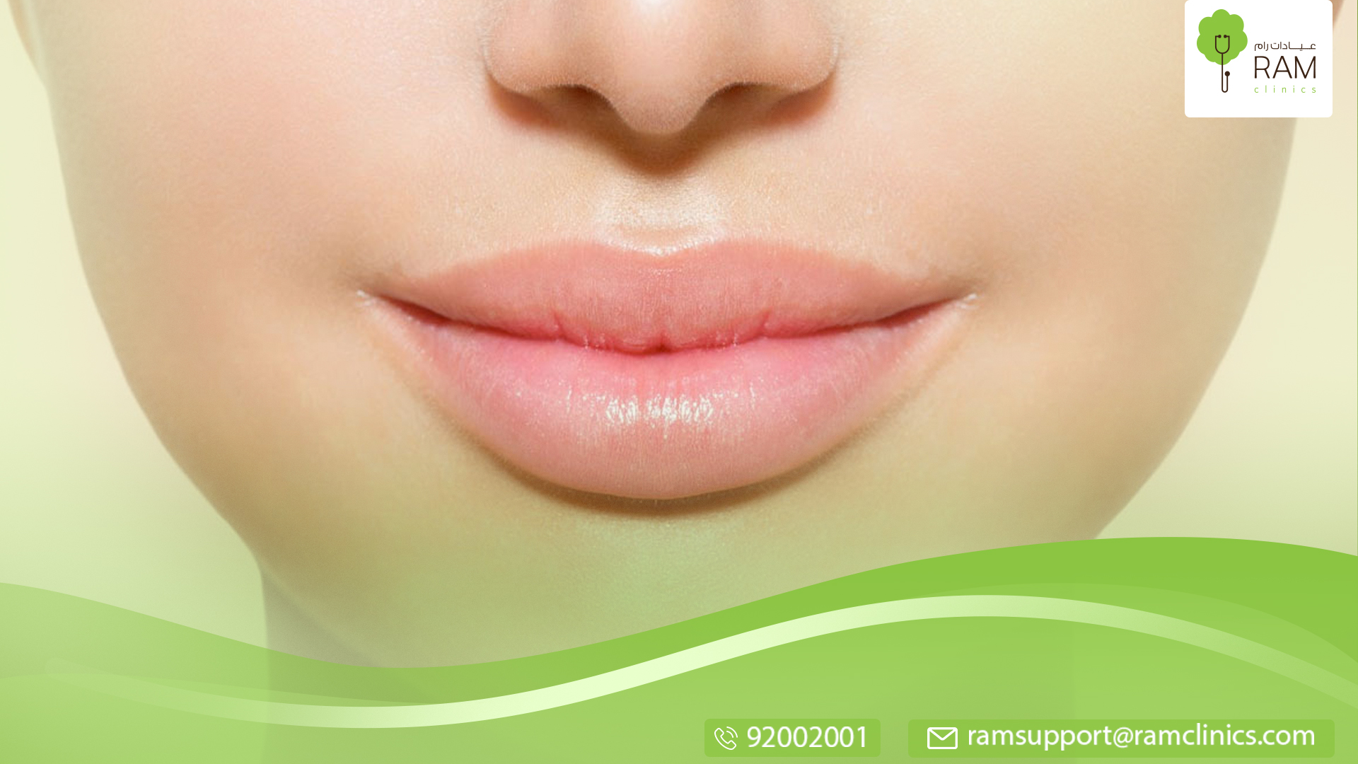 تكتل الفيلر في الشفايف