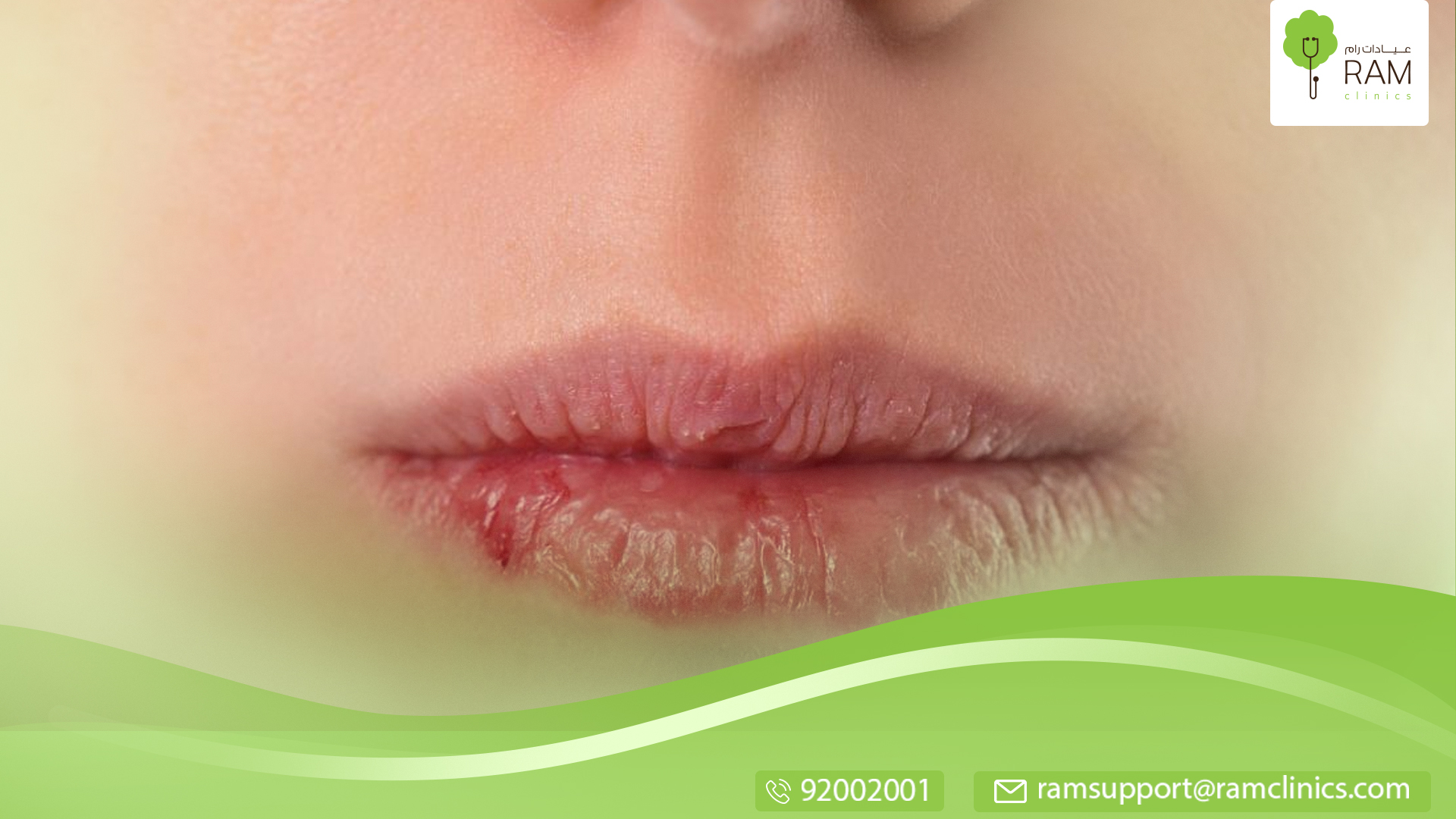 تورم الشفاة