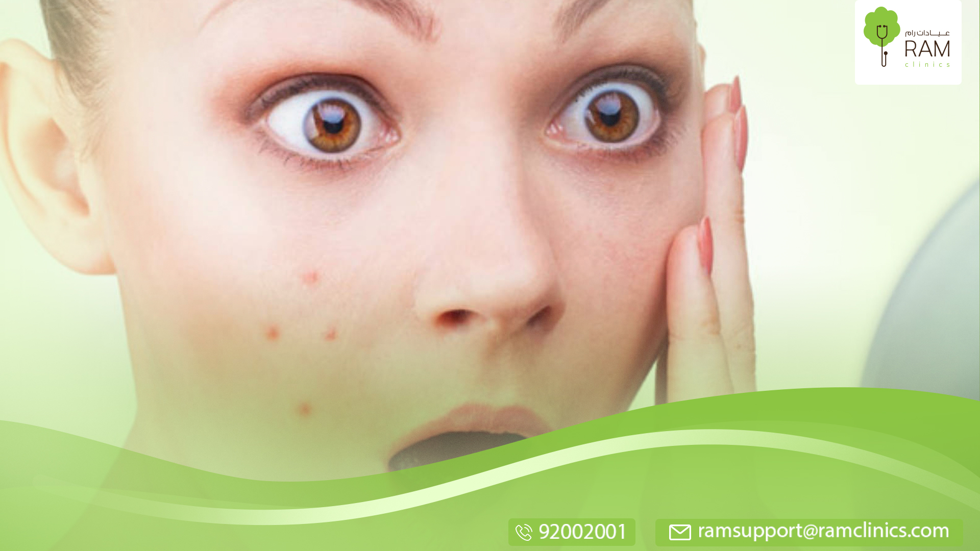 حب الشباب البنية