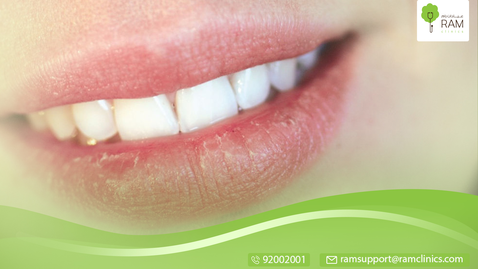 علاج تشقق الشفاه