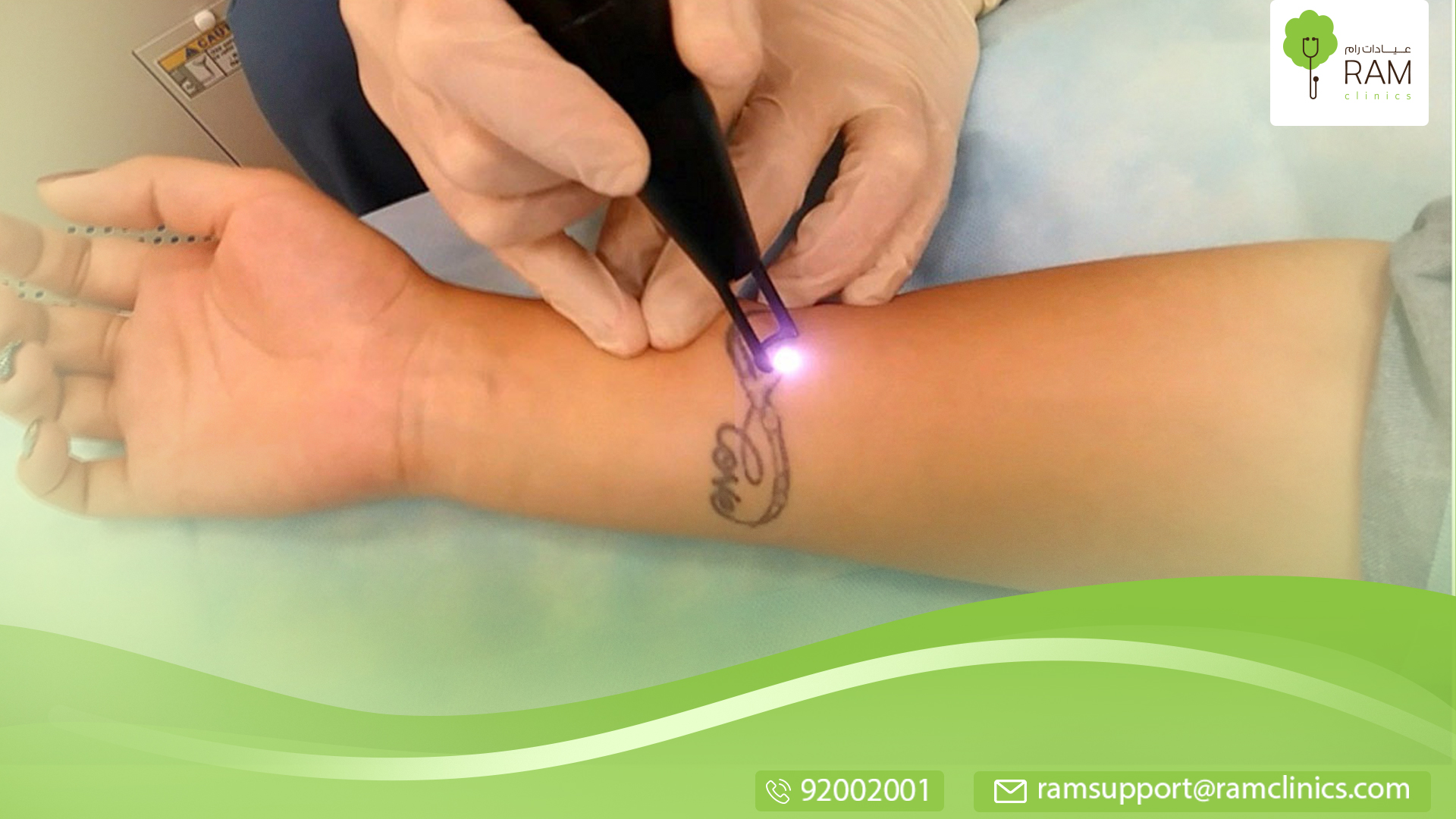 ازالة التاتو