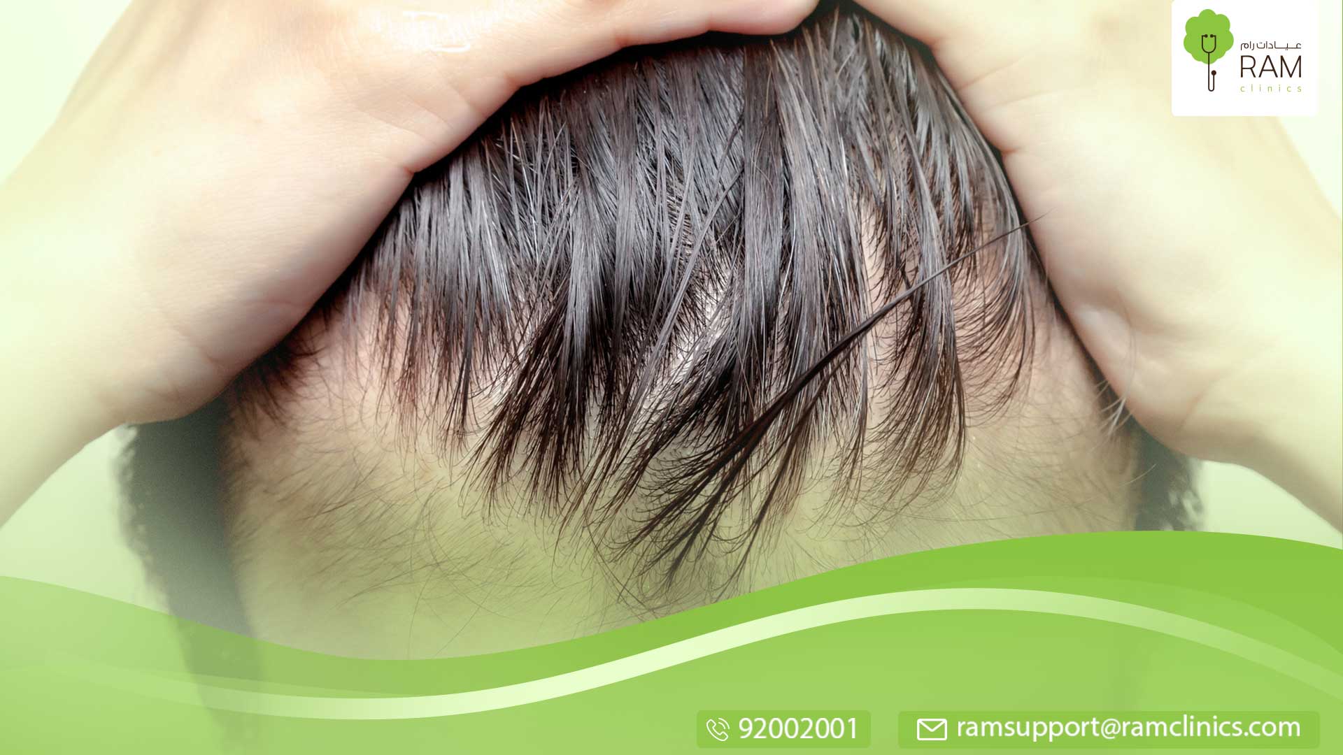 الصلع عند الرجال