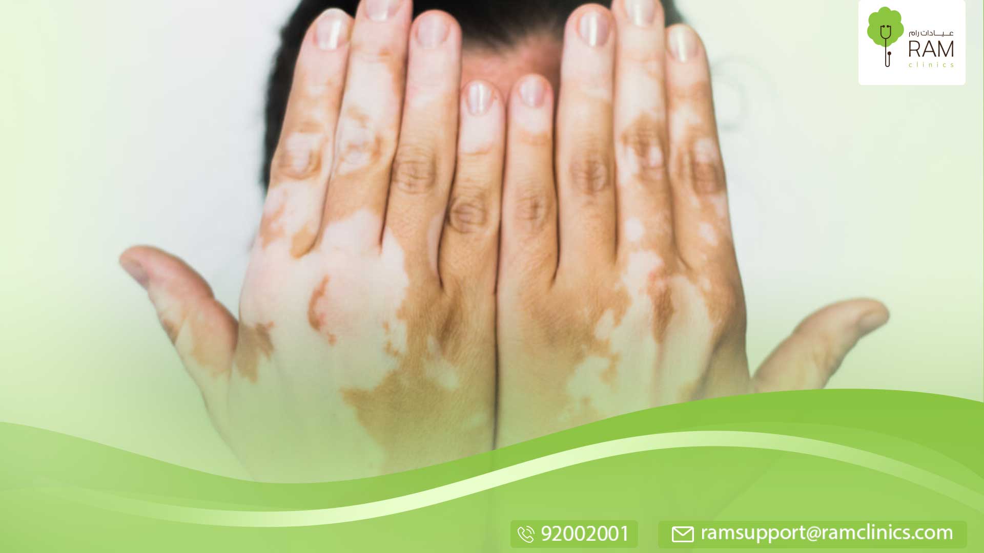 ما هو لون البهاق في بدايته