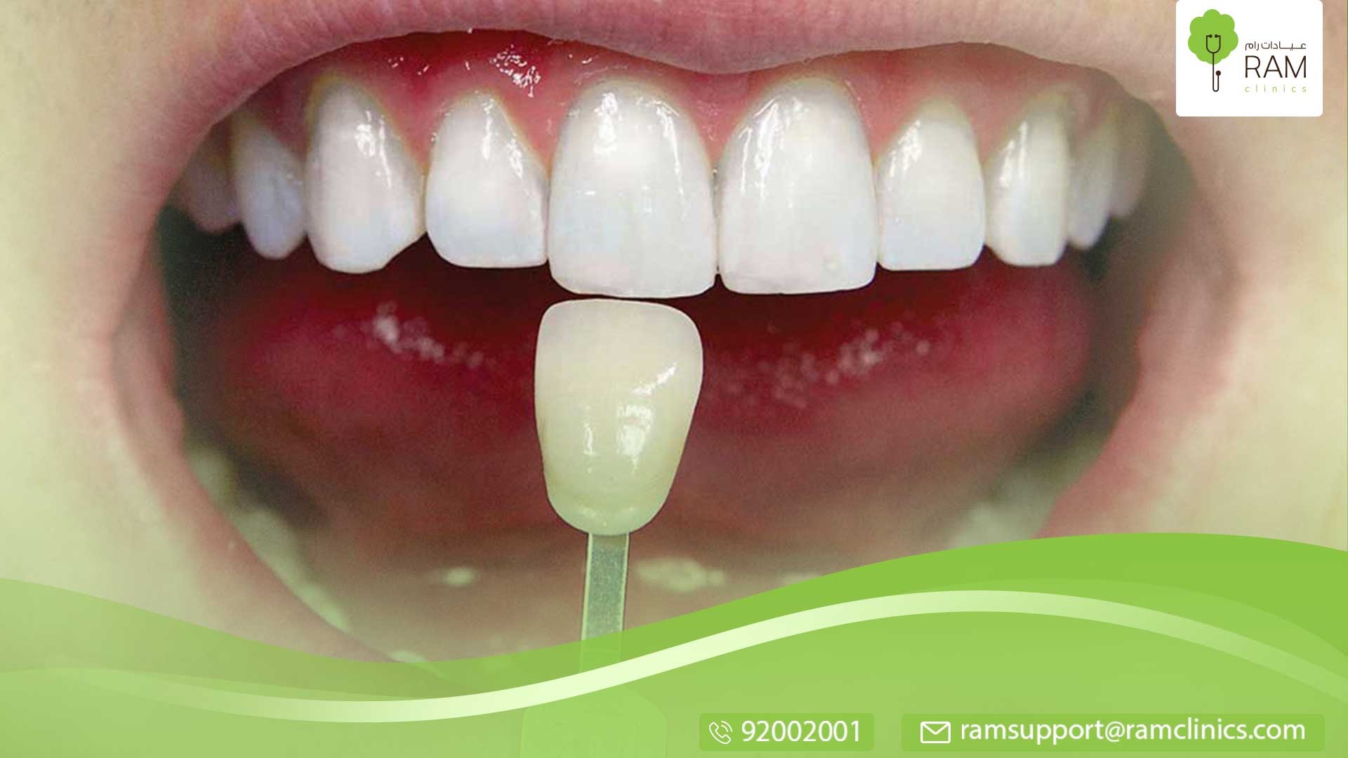 تبييض الأسنان