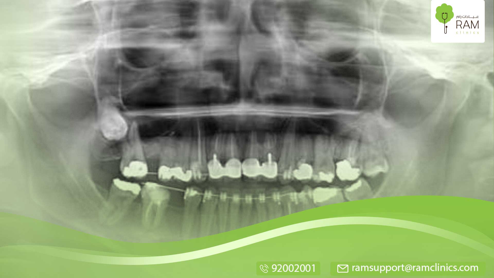 الهدف من اشعة الاسنان