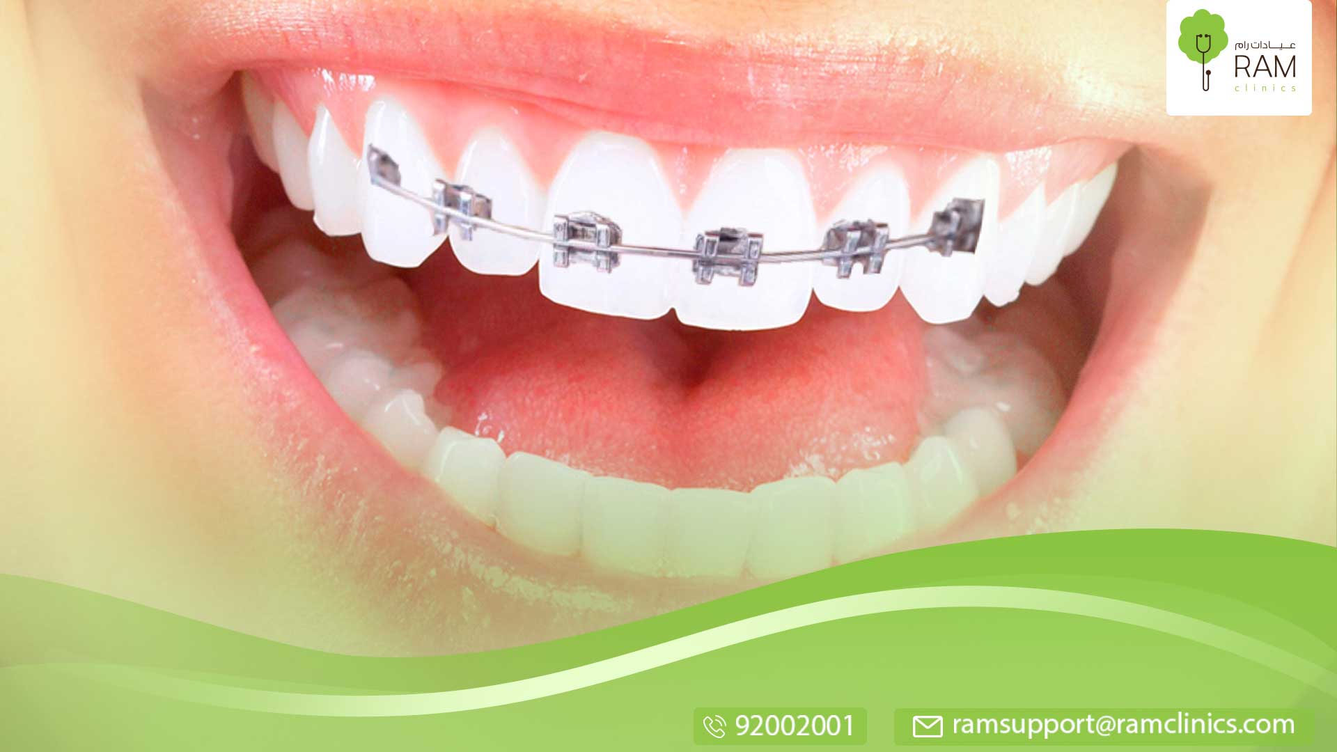 تبيض الأسنان بالمنزل