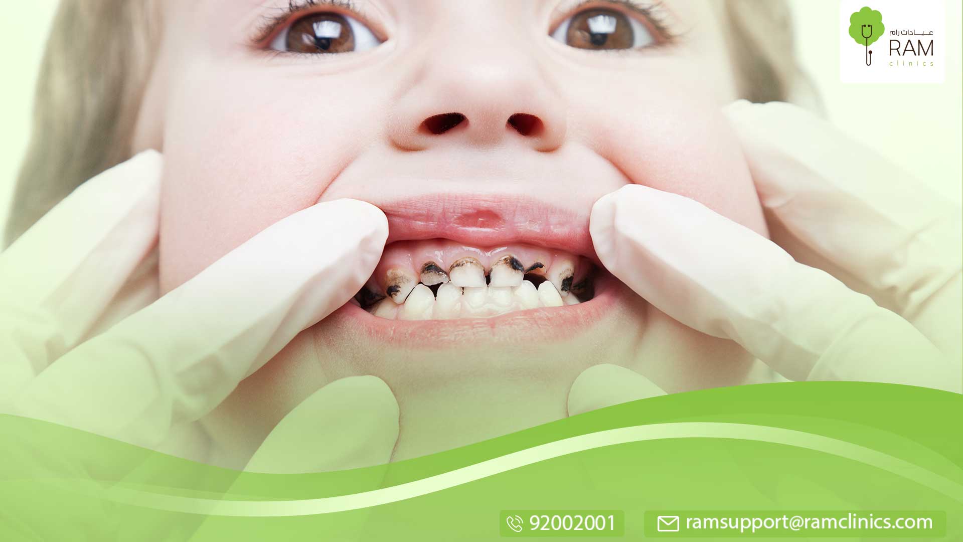 تسوس أسنان الرضع