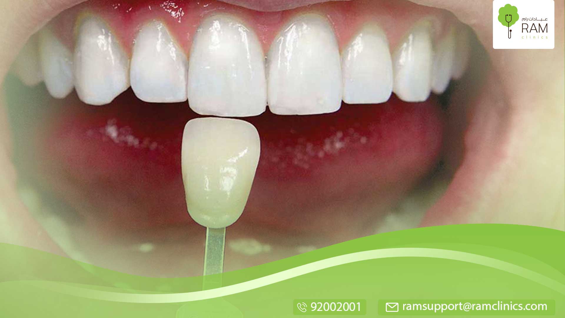 لون الاسنان  الطبيعي