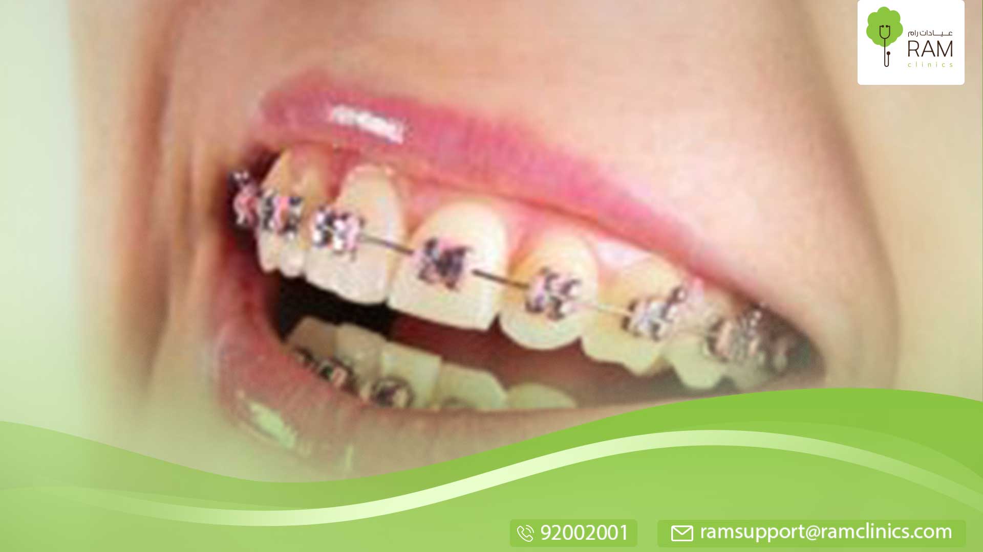 هل تقويم الأسنان يعرض الوجه