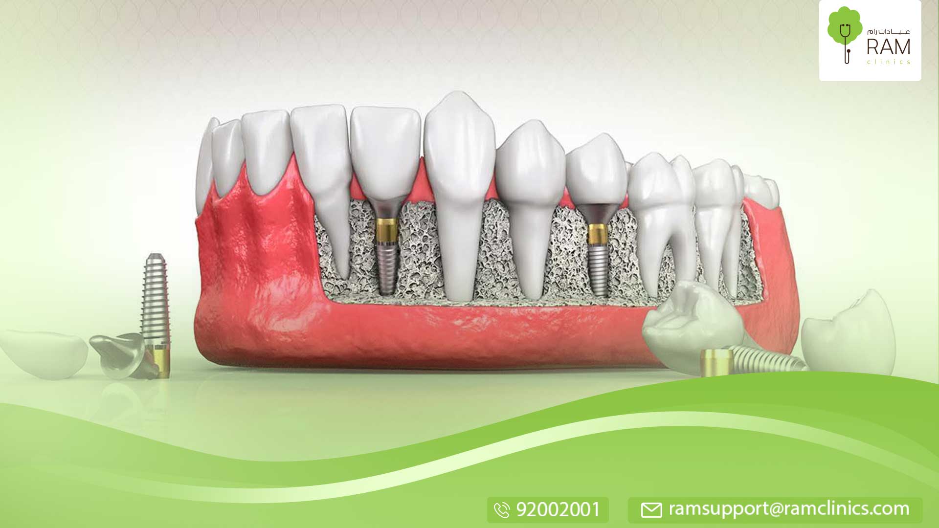 زراعة الأسنان دليلك