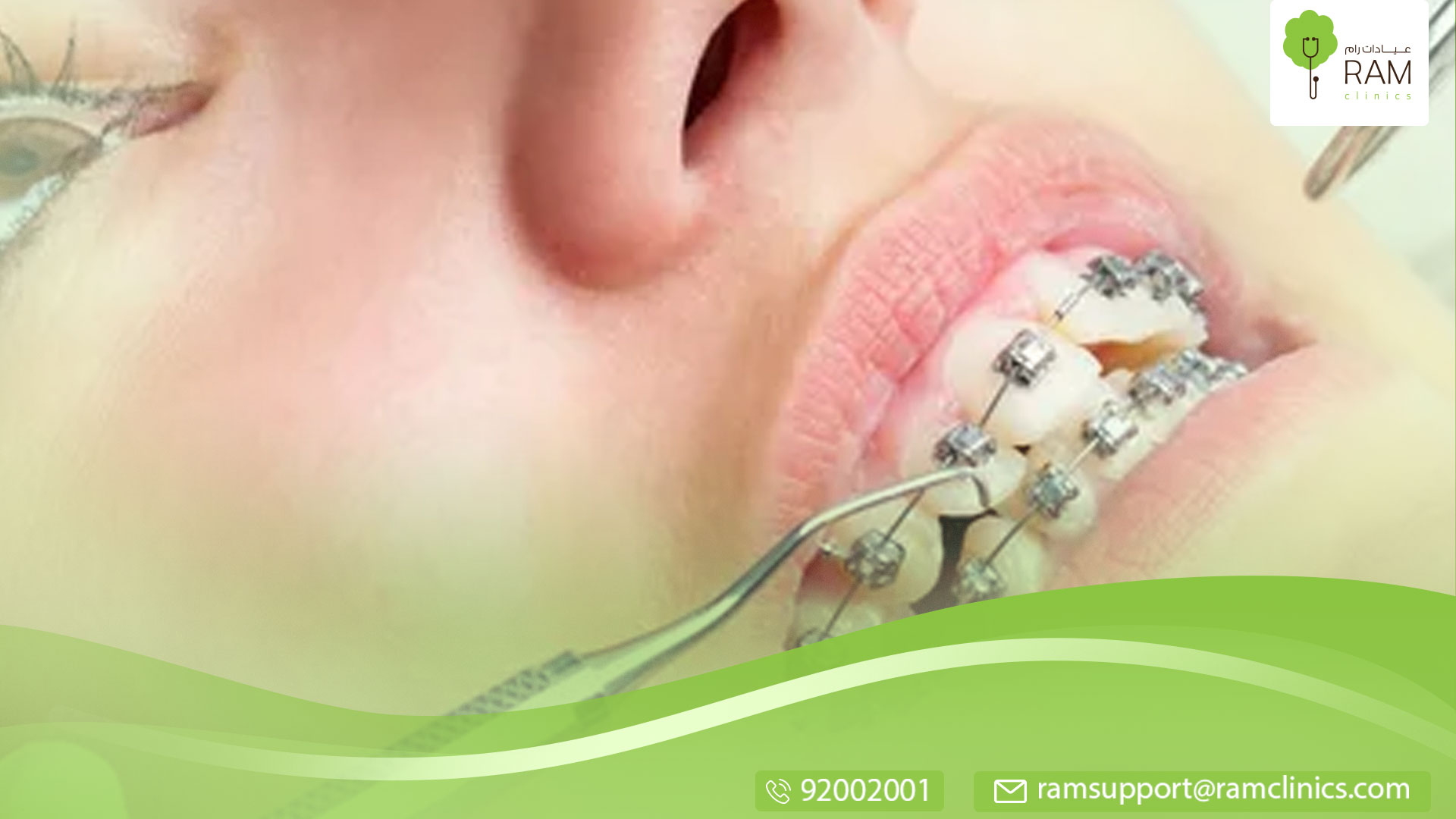 تركيب تقويم الأسنان