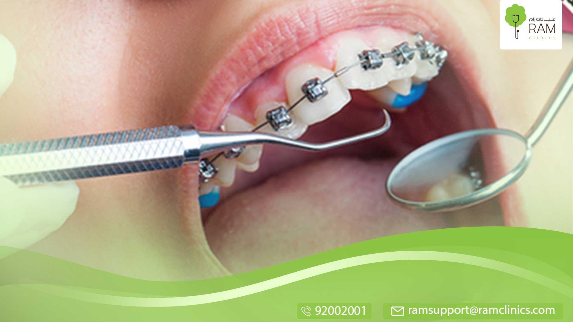 تأثير قلع الاسنان