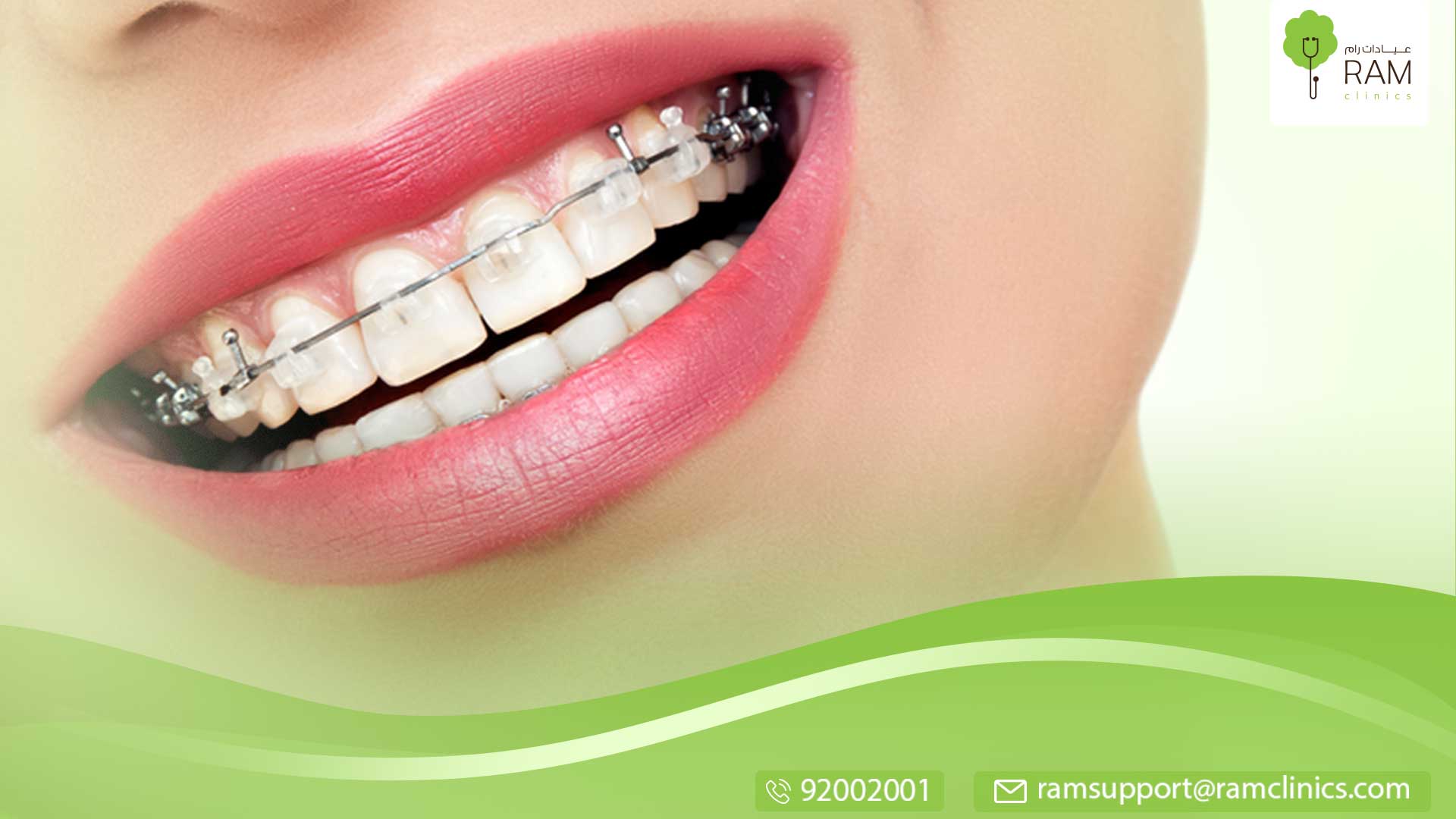 تقويم الأسنان الثابت