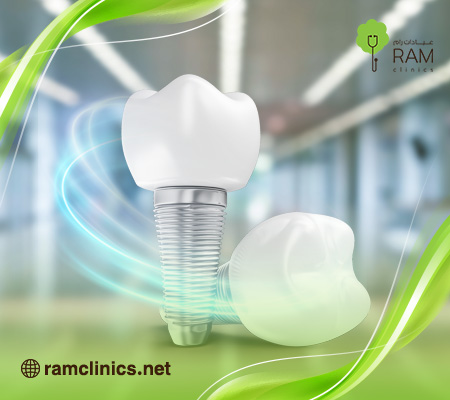 زراعة-الاسنان