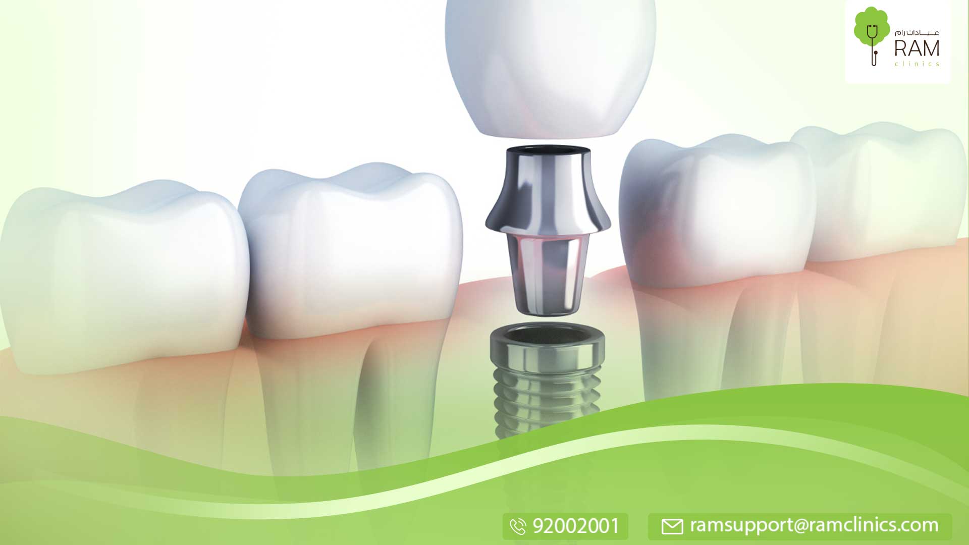 معلومات عن زراعة الاسنان