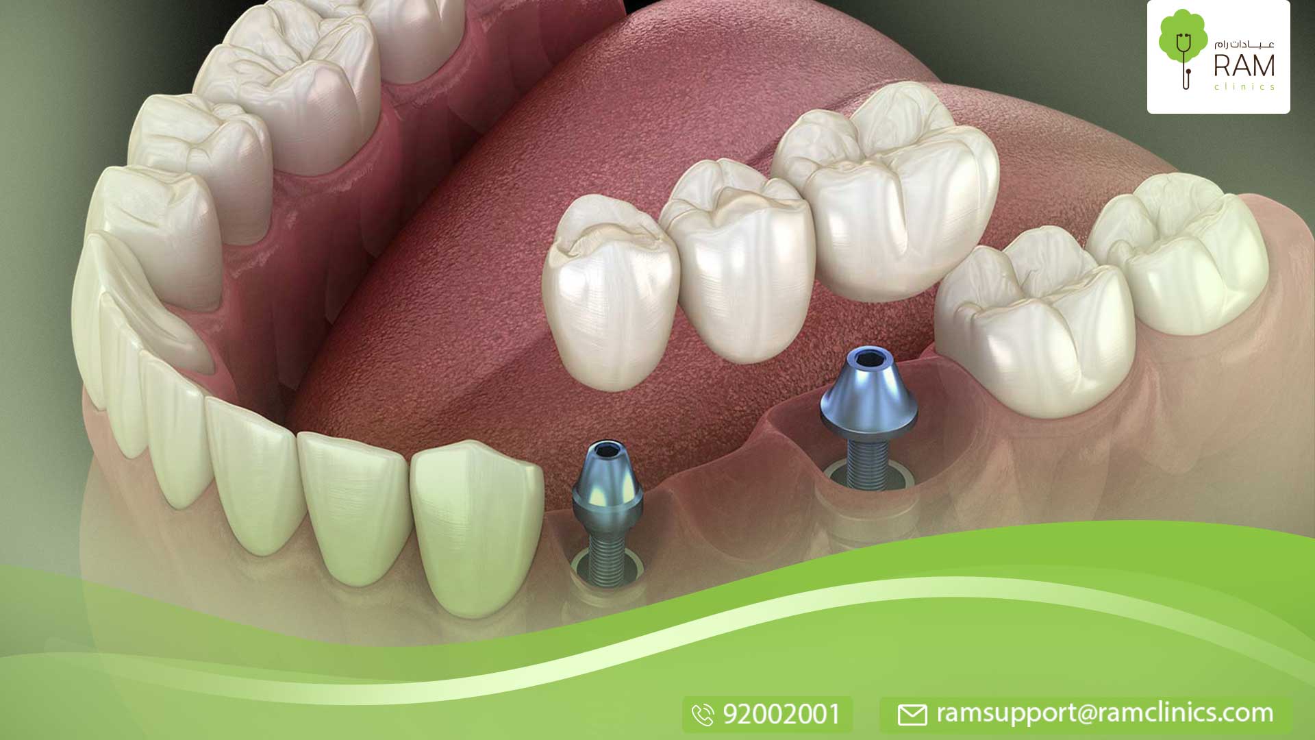 عدد أسنان العقل