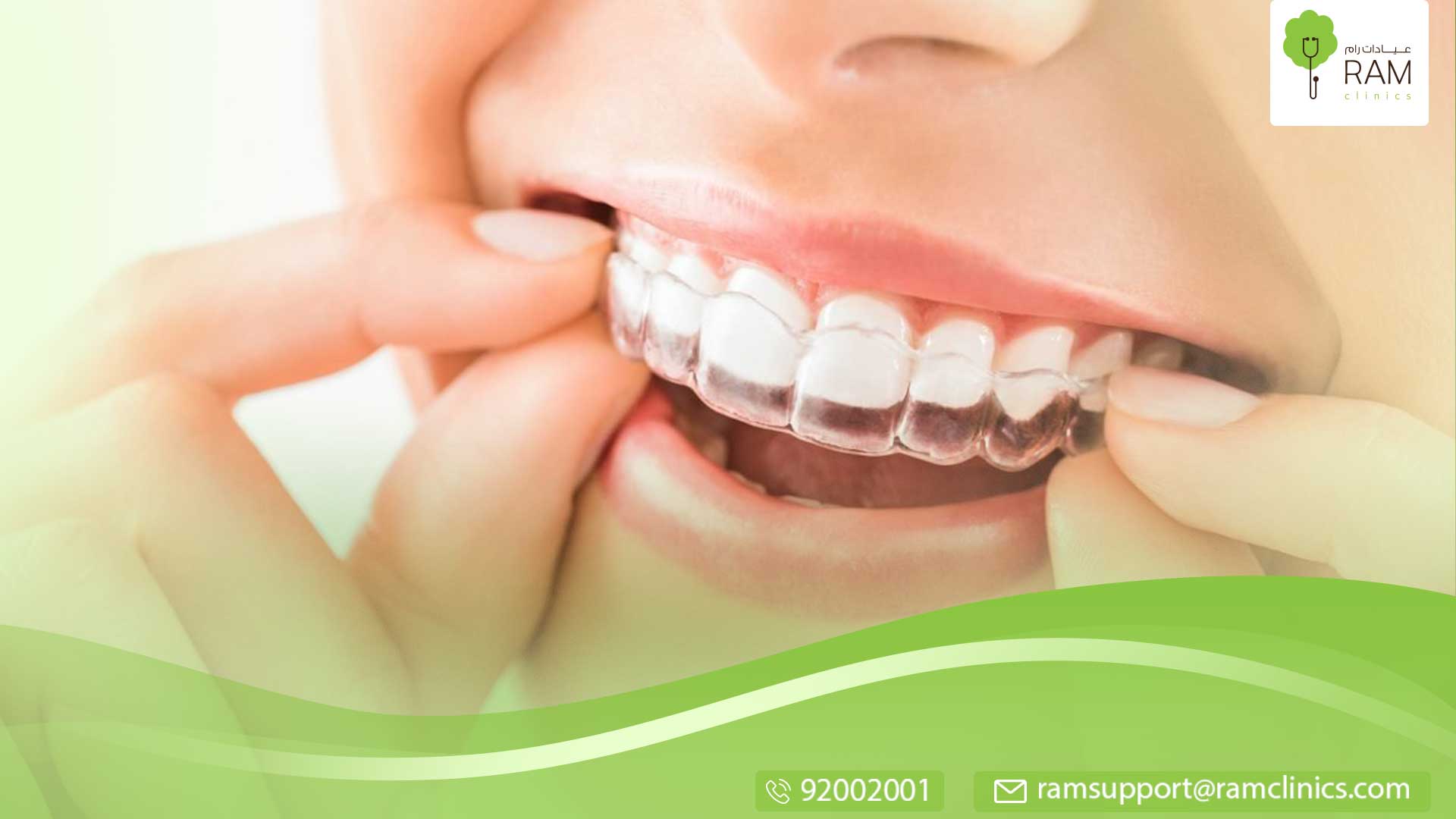 معلومات عن جسر الاسنان