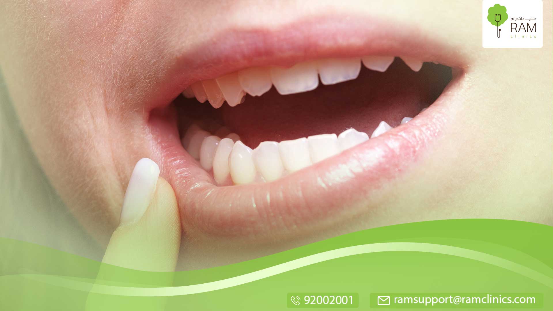 تقرحات الفم