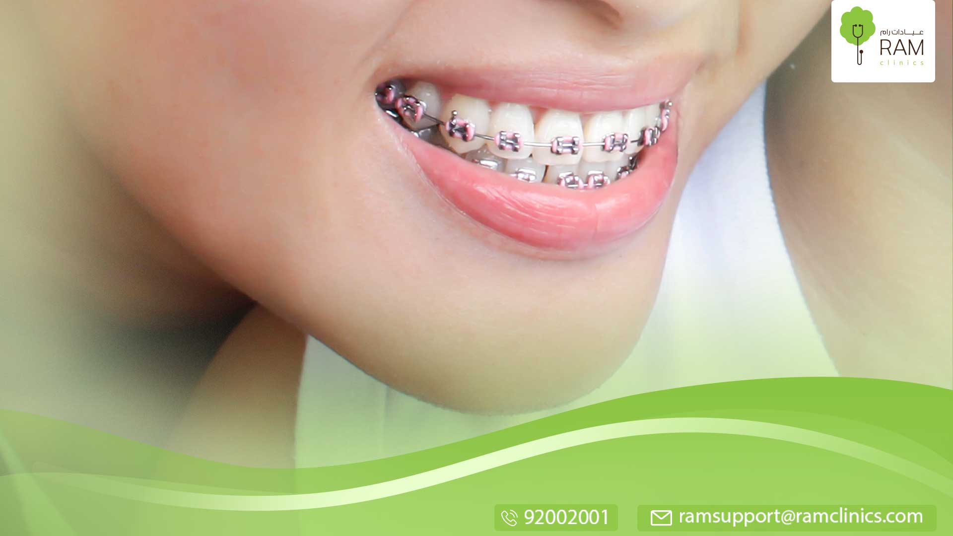 بعد تقويم الاسنان