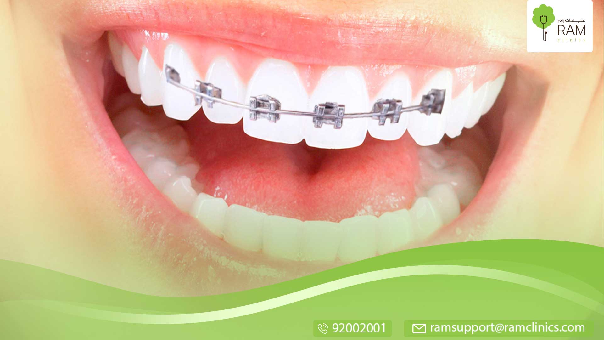 مخاطر تبييض الأسنان