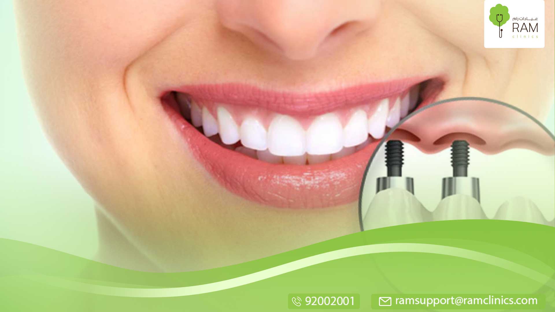 زراعة الاسنان تسبب كثير من الانزعاج