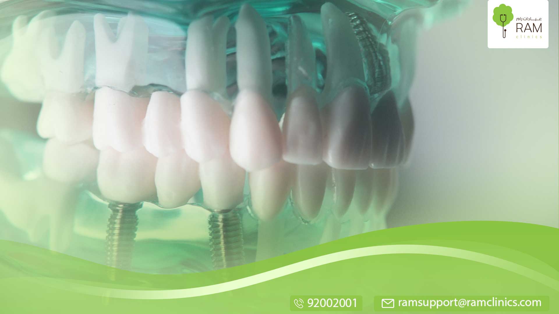 دليلك الشامل زراعة الاسنان