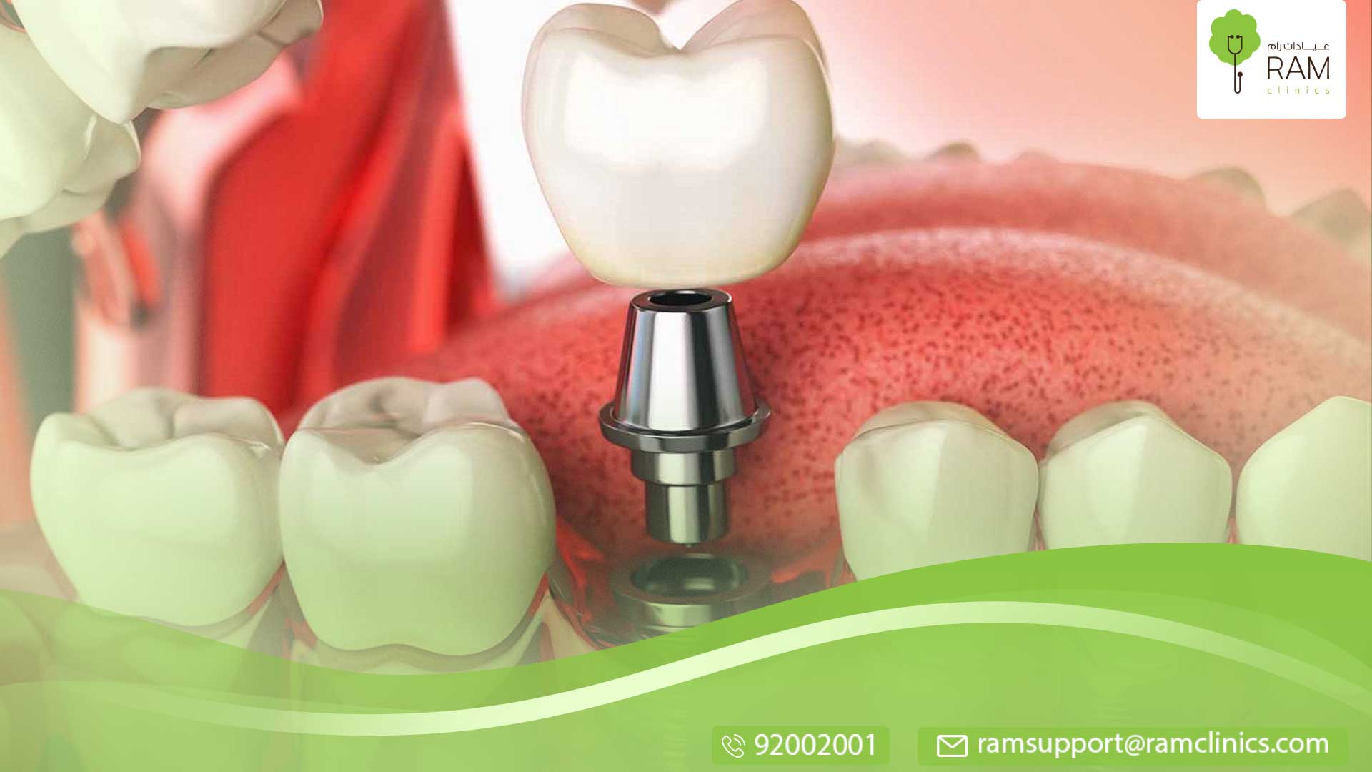 فوائد تركيب الاسنان