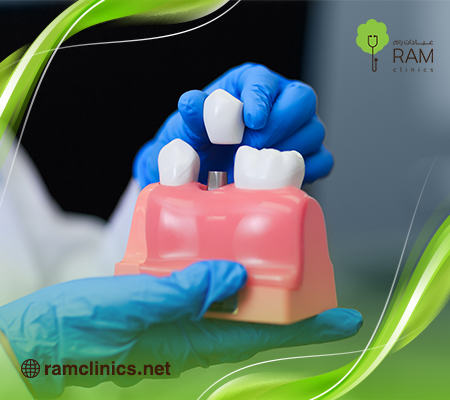 مدة زراعة الاسنان