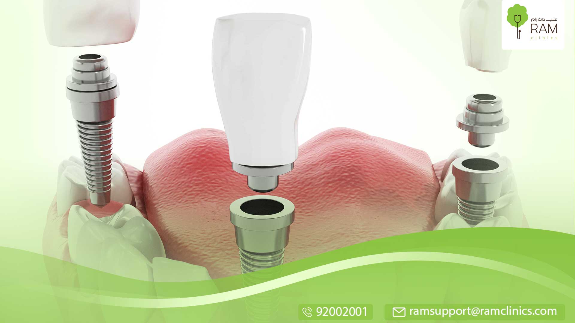 نجاح زراعة الأسنان