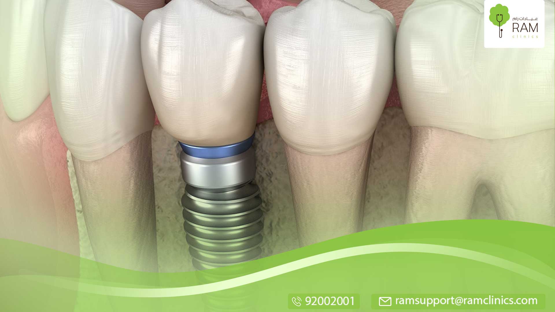 زرع الأسنان