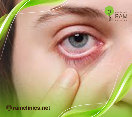 جفاف العيون