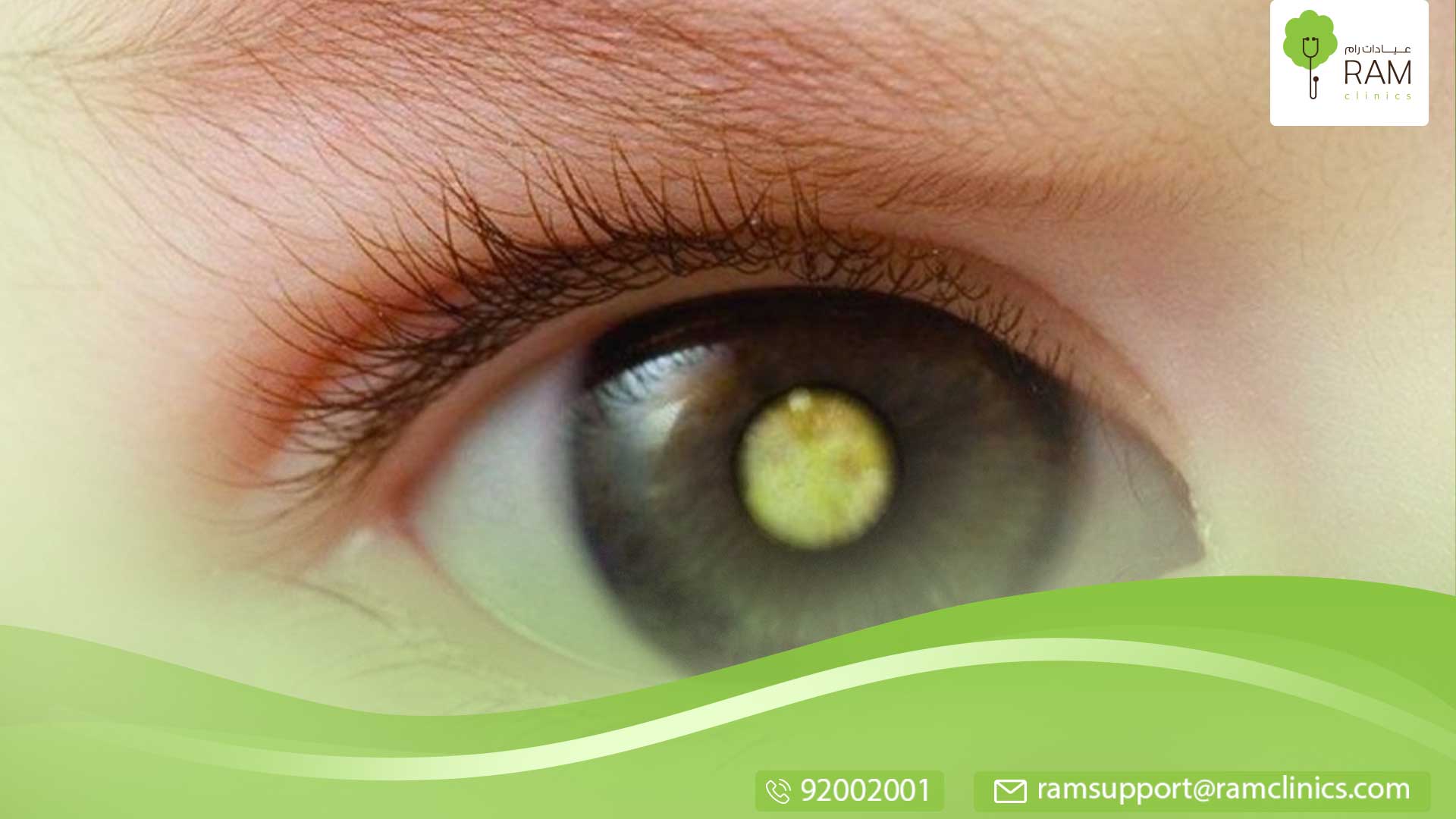 سرطان العين