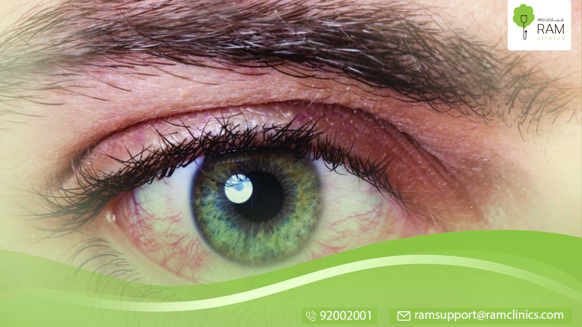 علاج تورم العين