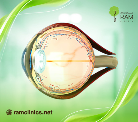 كيف-يرى-مريض-القرنية-المخروطية؟