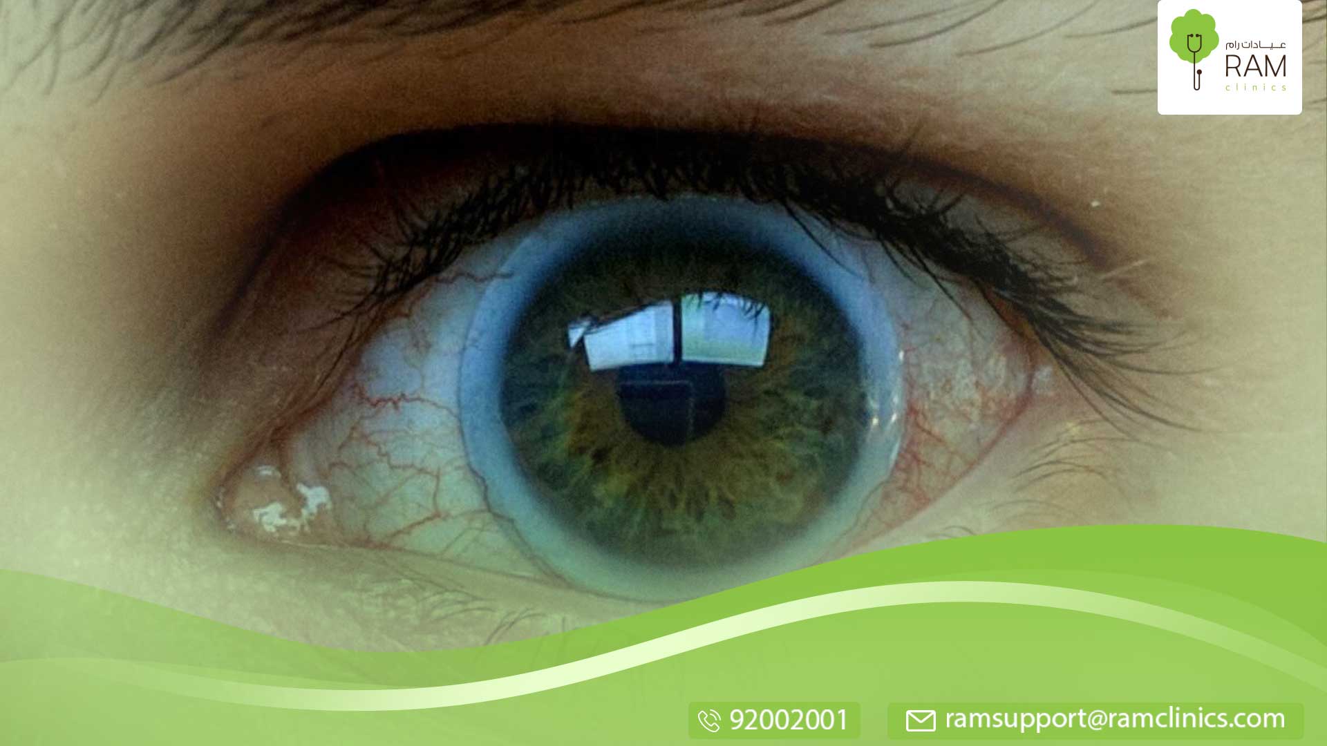 قرحة القرنية