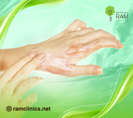 علاج-الحروق-البسيطة