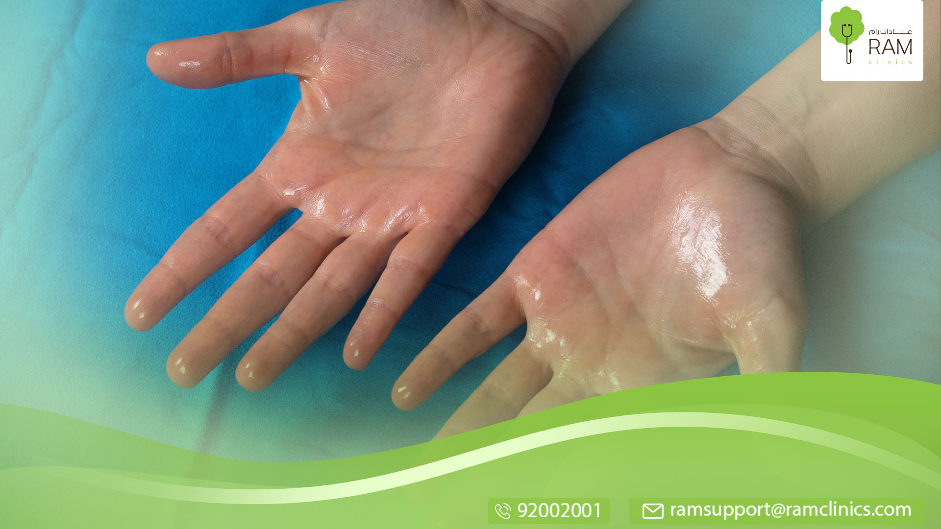 تخلص من تعرق اليدين والقدمين