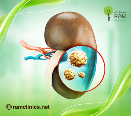 علاج-حصوة-الكلى