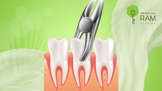 تقنيات خلع الأسنان
