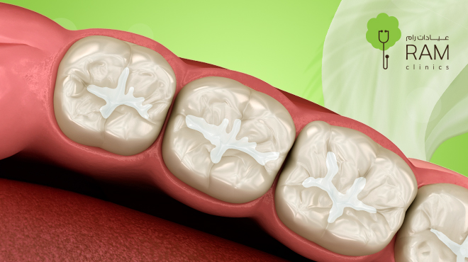 ما تقدمه عيادات رام في تقنيات حشوات الأسنان