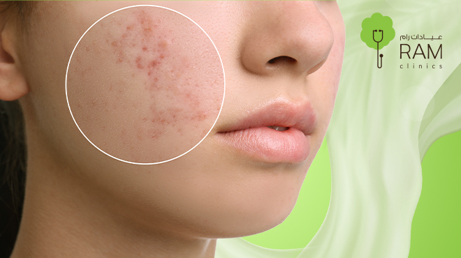 علاج تصبغ البشرة