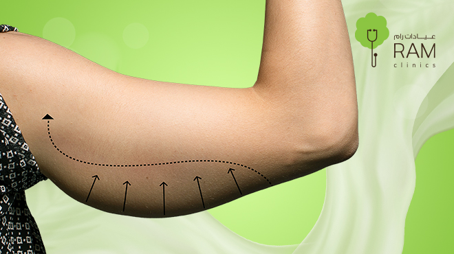 ما تقدمه عيادات رام في جراحات شفط دهون الذراعين