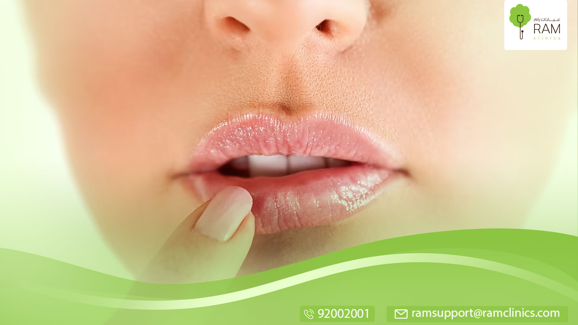 جفاف حول الفم