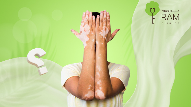 طرق علاج للبهاق