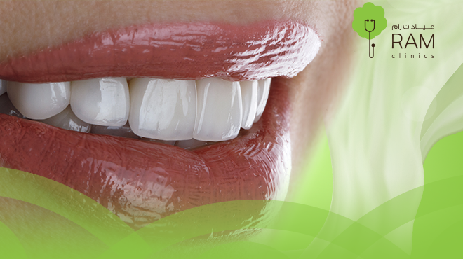 تكلفة ابتسامة هوليود