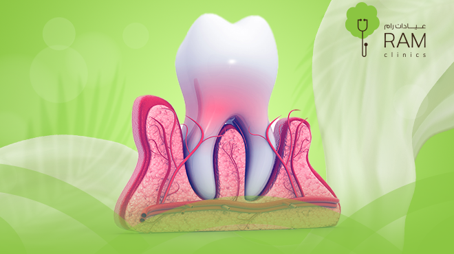 علاج جذور الأسنان