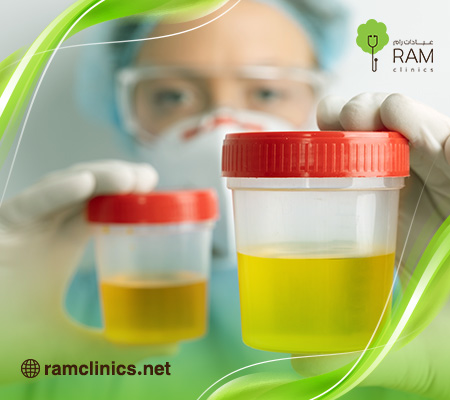 تغير-لون-البول